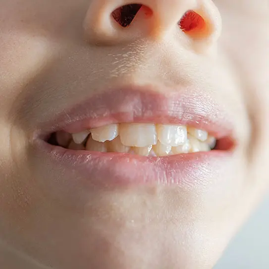 Gum Disease Can Affect Kids Too -