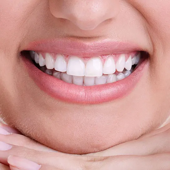 brush dental veneers