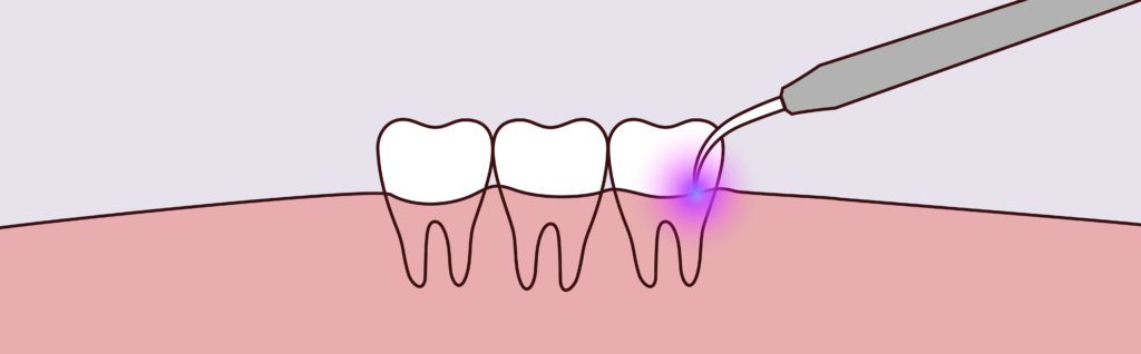 laser therapy dentist Olney MD