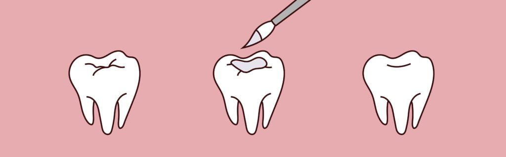 Dental Sealants -