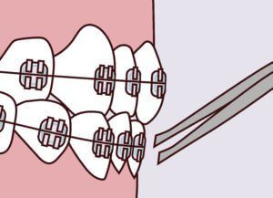 Orthodontic Emergencies -