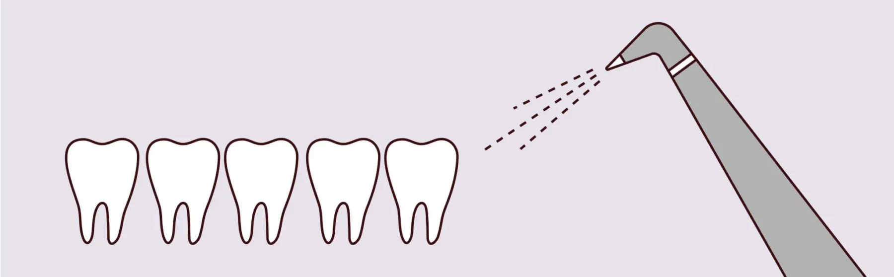 Air Abrasion Dentistry -
