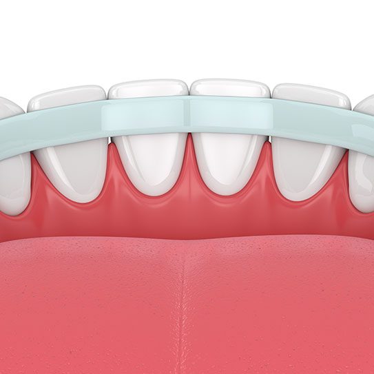 dental splints for loose teeth periodontal splints